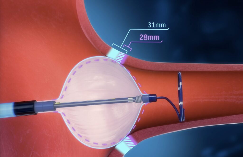 FDA Recall Alert: Critical Catheter Used in Surgeries Pulled Over Risk of Tip Separation 2 Critical Catheter