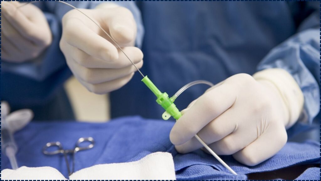 FDA Recall Alert: Critical Catheter Used in Surgeries Pulled Over Risk of Tip Separation 1 FDA Recall Alert